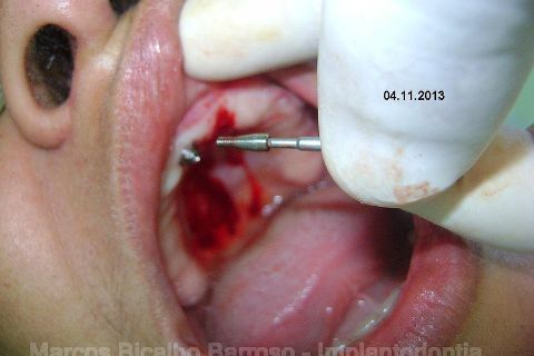 Fase Protética da Reabilitação em Maxila Atrófica