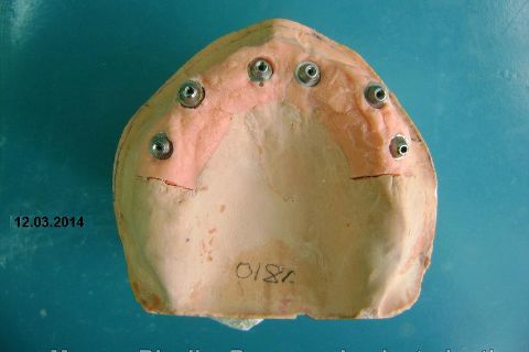 Fase Protética da Reabilitação em Maxila Atrófica