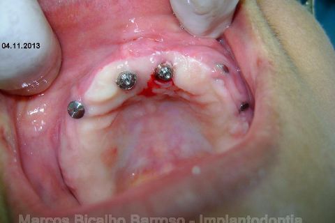 Fase Protética da Reabilitação em Maxila Atrófica