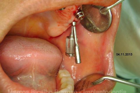 Fase Protética da Reabilitação em Maxila Atrófica