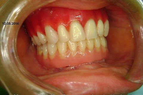 Fase Protética da Reabilitação em Maxila Atrófica