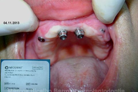 Fase Protética da Reabilitação em Maxila Atrófica