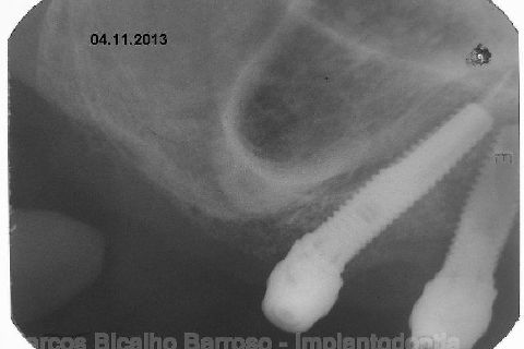 Fase Protética da Reabilitação em Maxila Atrófica