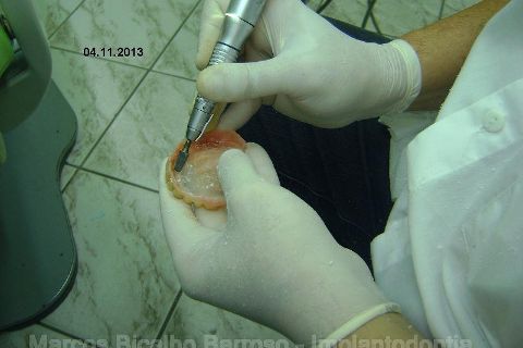 Fase Protética da Reabilitação em Maxila Atrófica