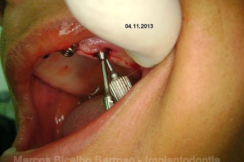 Fase Protética da Reabilitação em Maxila Atrófica