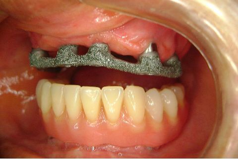 Fase Protética da Reabilitação em Maxila Atrófica