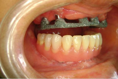 Fase Protética da Reabilitação em Maxila Atrófica