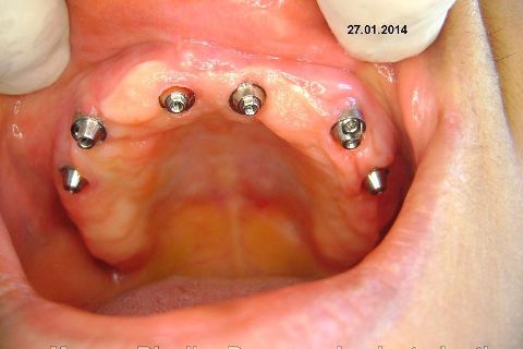 Fase Protética da Reabilitação em Maxila Atrófica