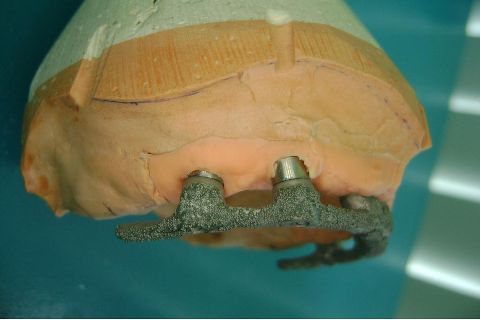 Fase Protética da Reabilitação em Maxila Atrófica