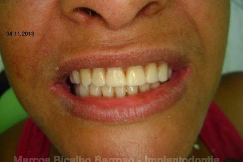 Fase Protética da Reabilitação em Maxila Atrófica