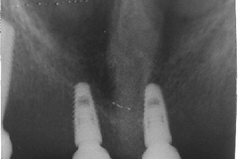 Fase Protética da Reabilitação em Maxila Atrófica