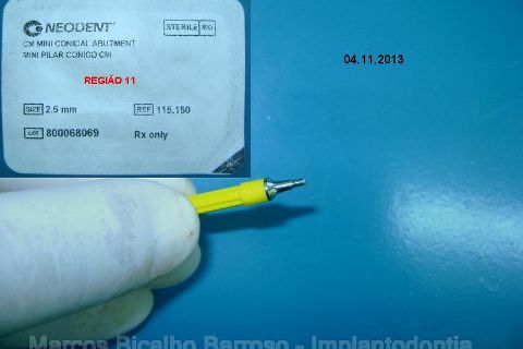 Fase Protética da Reabilitação em Maxila Atrófica