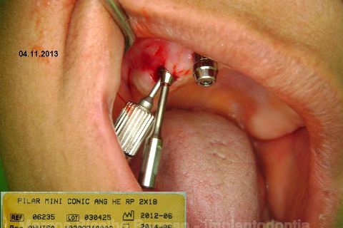 Fase Protética da Reabilitação em Maxila Atrófica