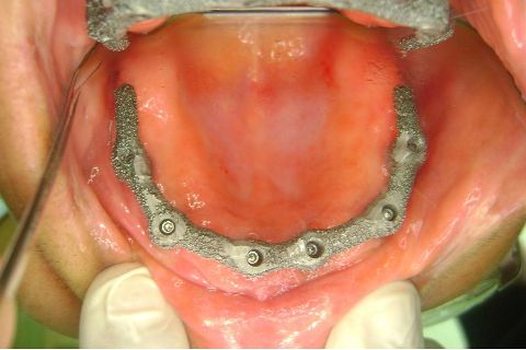 Fase Protética da Reabilitação em Maxila Atrófica