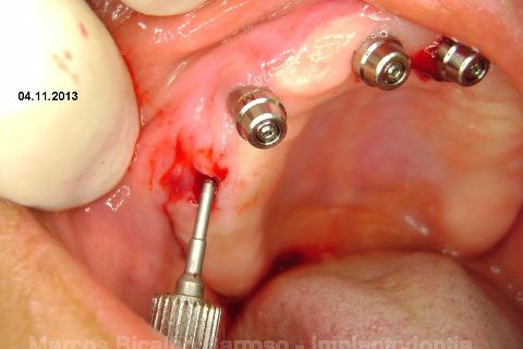 Fase Protética da Reabilitação em Maxila Atrófica