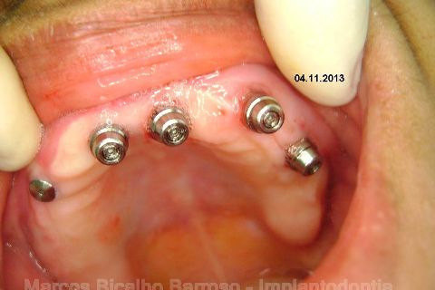 Fase Protética da Reabilitação em Maxila Atrófica