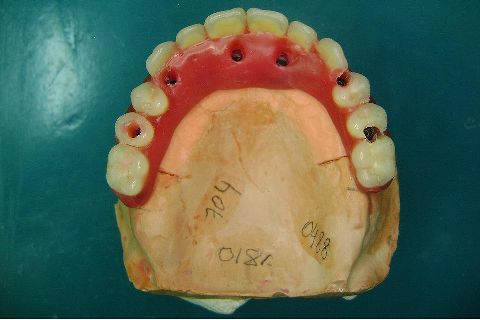 Fase Protética da Reabilitação em Maxila Atrófica