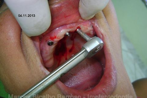 Fase Protética da Reabilitação em Maxila Atrófica