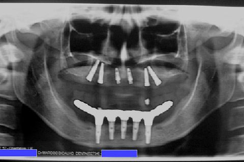 Fase Protética da Reabilitação em Maxila Atrófica