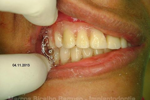 Fase Protética da Reabilitação em Maxila Atrófica