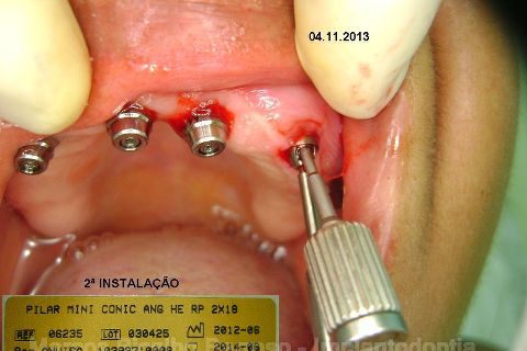 Fase Protética da Reabilitação em Maxila Atrófica