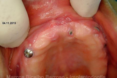 Fase Protética da Reabilitação em Maxila Atrófica