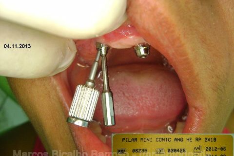 Fase Protética da Reabilitação em Maxila Atrófica