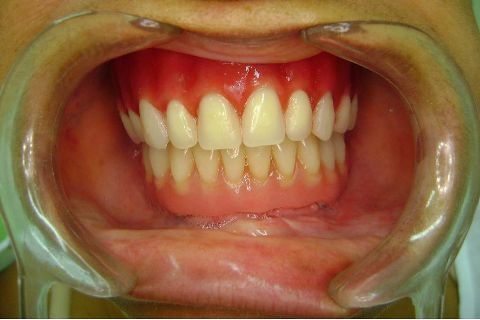 Fase Protética da Reabilitação em Maxila Atrófica