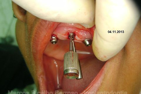 Fase Protética da Reabilitação em Maxila Atrófica