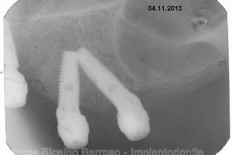 Fase Protética da Reabilitação em Maxila Atrófica
