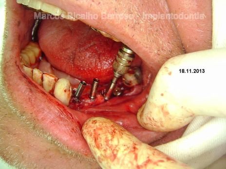 Implantes Cone Morse com Carga Imediata em Região Posterior de Mandíbula