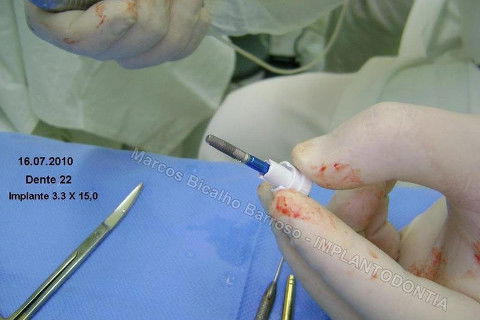 Implante Unitário - Resolução para Situações de Fraturas Radiculares com Ocorrência de Inflamação / Infecção