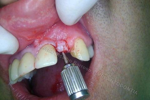 Implante Unitário - Resolução para Situações de Fraturas Radiculares com Ocorrência de Inflamação / Infecção