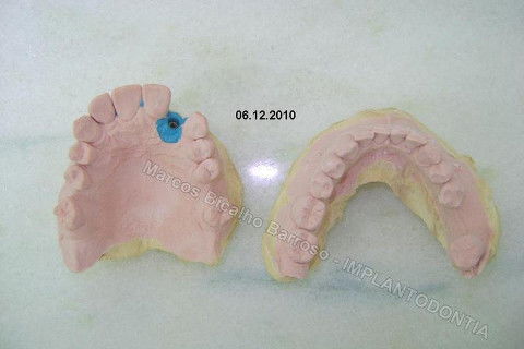 Implante Unitário - Resolução para Situações de Fraturas Radiculares com Ocorrência de Inflamação / Infecção