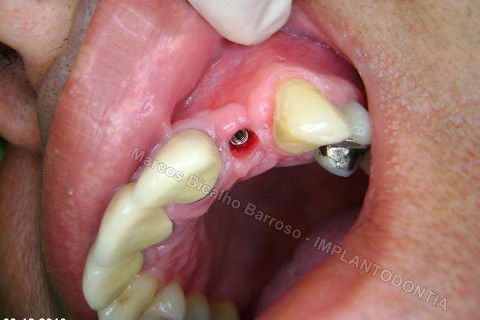 Implante Unitário - Resolução para Situações de Fraturas Radiculares com Ocorrência de Inflamação / Infecção