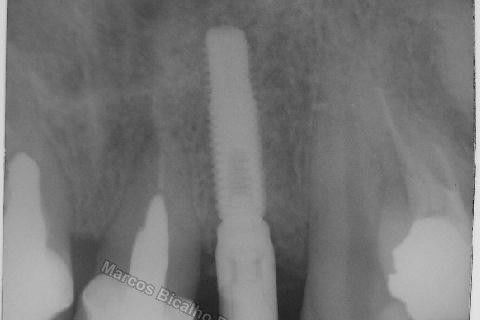 Implante Unitário - Resolução para Situações de Fraturas Radiculares com Ocorrência de Inflamação / Infecção