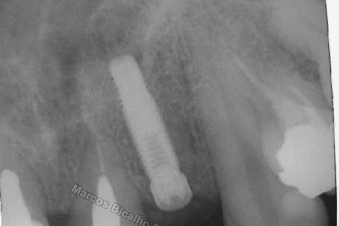 Implante Unitário - Resolução para Situações de Fraturas Radiculares com Ocorrência de Inflamação / Infecção