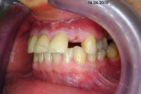 Implante Unitário - Resolução para Situações de Fraturas Radiculares com Ocorrência de Inflamação / Infecção