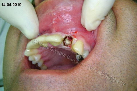Gengivectomia com bisturi eletrônico, facilitando acesso à raiz e consequentemente uma exodontia atraumática, sem perda óssea.