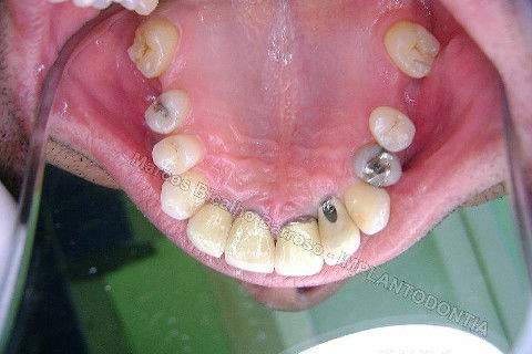 Implante Unitário - Resolução para Situações de Fraturas Radiculares com Ocorrência de Inflamação / Infecção