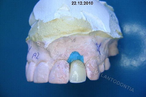 Implante Unitário - Resolução para Situações de Fraturas Radiculares com Ocorrência de Inflamação / Infecção