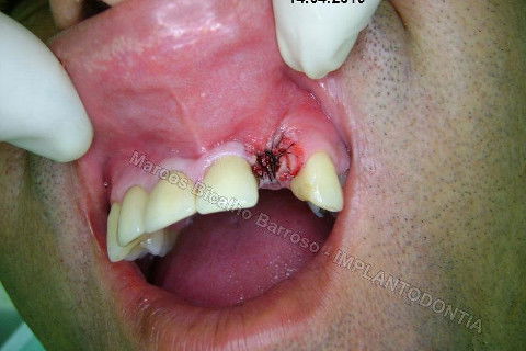 Implante Unitário - Resolução para Situações de Fraturas Radiculares com Ocorrência de Inflamação / Infecção