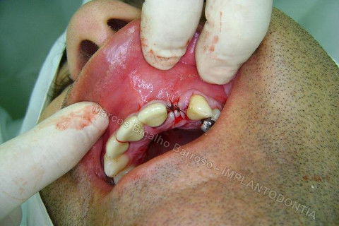 Implante Unitário - Resolução para Situações de Fraturas Radiculares com Ocorrência de Inflamação / Infecção