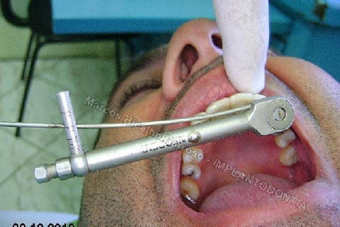 Torque de 32 N sobre o parafuso protético.