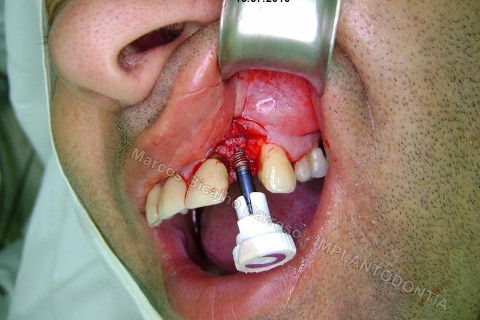 Implante Unitário - Resolução para Situações de Fraturas Radiculares com Ocorrência de Inflamação / Infecção