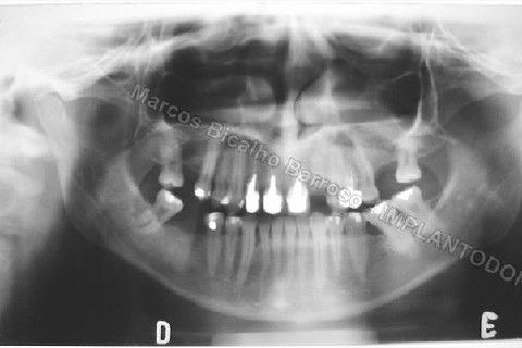 Implante Unitário - Resolução para Situações de Fraturas Radiculares com Ocorrência de Inflamação / Infecção