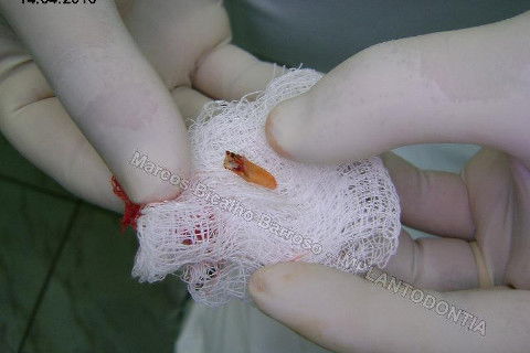 Implante Unitário - Resolução para Situações de Fraturas Radiculares com Ocorrência de Inflamação / Infecção