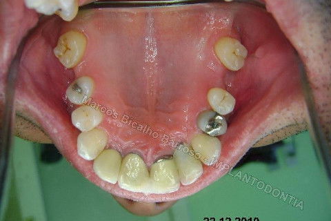 Implante Unitário - Resolução para Situações de Fraturas Radiculares com Ocorrência de Inflamação / Infecção