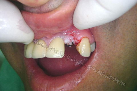 Implante Unitário - Resolução para Situações de Fraturas Radiculares com Ocorrência de Inflamação / Infecção