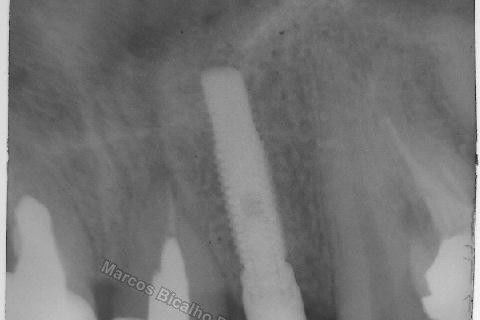 Implante Unitário - Resolução para Situações de Fraturas Radiculares com Ocorrência de Inflamação / Infecção